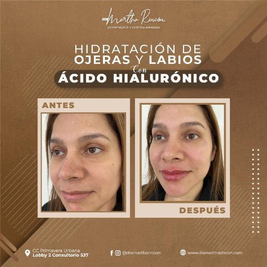 Aquapure Estándar – Unidad Dermatológica Villavicencio